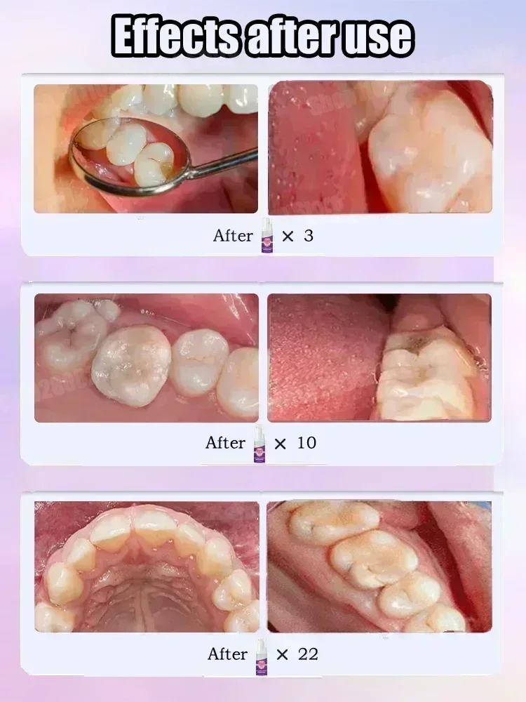 科学的な修復により、虫歯を取り除き、歯垢をきれいにし、歯を白 - Teeth Whitening Best のレビューと価格
